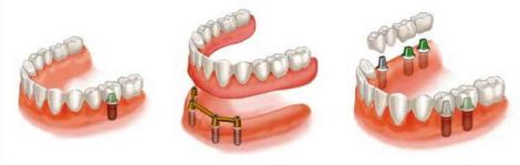 Zubni implantanti u Varazdinu